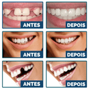 Facetas Dentárias Universal Smile [Últimas Unidades]